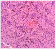 Giant-Cell Tumor of the Patella
