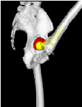 Impingement-free Range of Motion After Total Hip Arthroplasty with A Cup-First TechniqueUsing a CT Navigation System