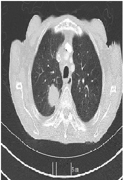 Primary (De Novo) EGFR T790M Mutation and High PD-L1 Expression in A Smoker with Metastatic Lung Adenocarcinoma: A Case Report and Literature Review