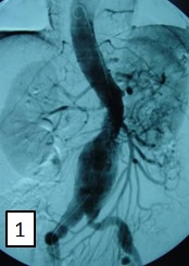 Mesenteric Revascularisation By Carrel Patch Technique in Abdominal Aortic Aneurysmectomy